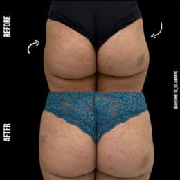 Radiesse Before & After - Aesthetic Island NYC